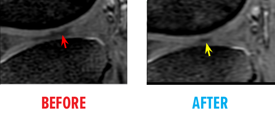 Third Example of MRI of Knee Osteochrondal Defect