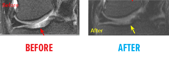 Fourth Example of MRI of Knee Osteochrondal Defect