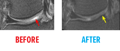 Sixth Example of MRI of Knee Osteochrondal Defect
