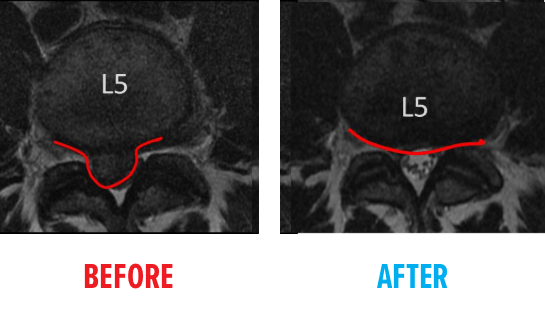 Spine MRI - Large Disc Herniation 