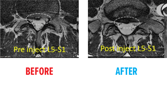 Lumbar disc annular tear MRI
