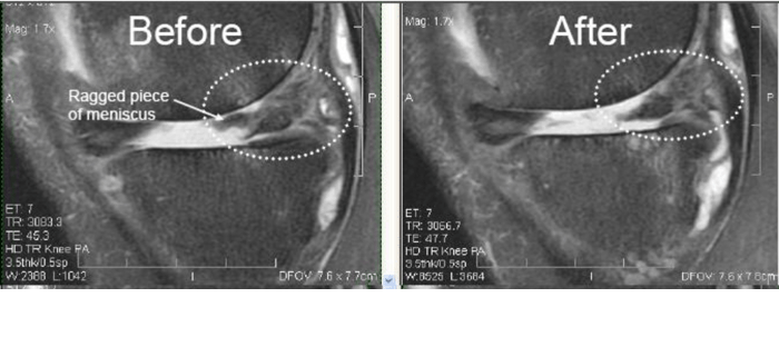 Miniscus Injury Before and After Regenexx Procedure