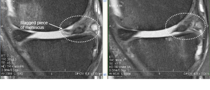 Miniscus Injury Before and After Regenexx Procedure