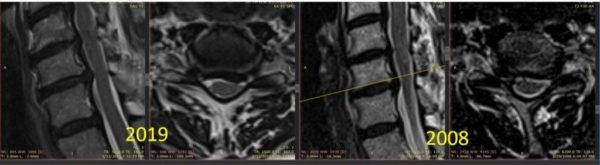MRI showing a spinal disc bulge in the neck in 2008 and 2019 