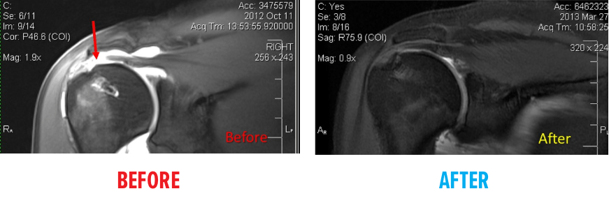 Retracted Rotator Cuff MRI