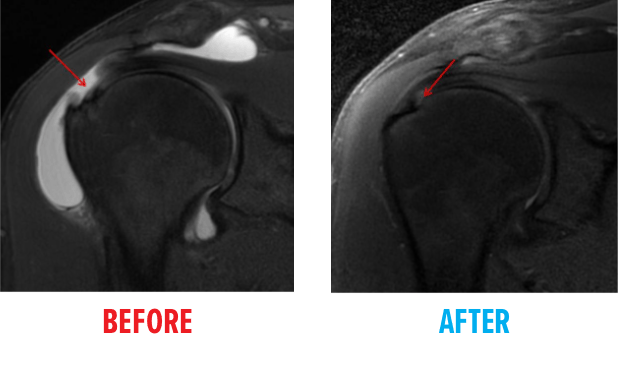 Shoulder MRI - Pain with Injections