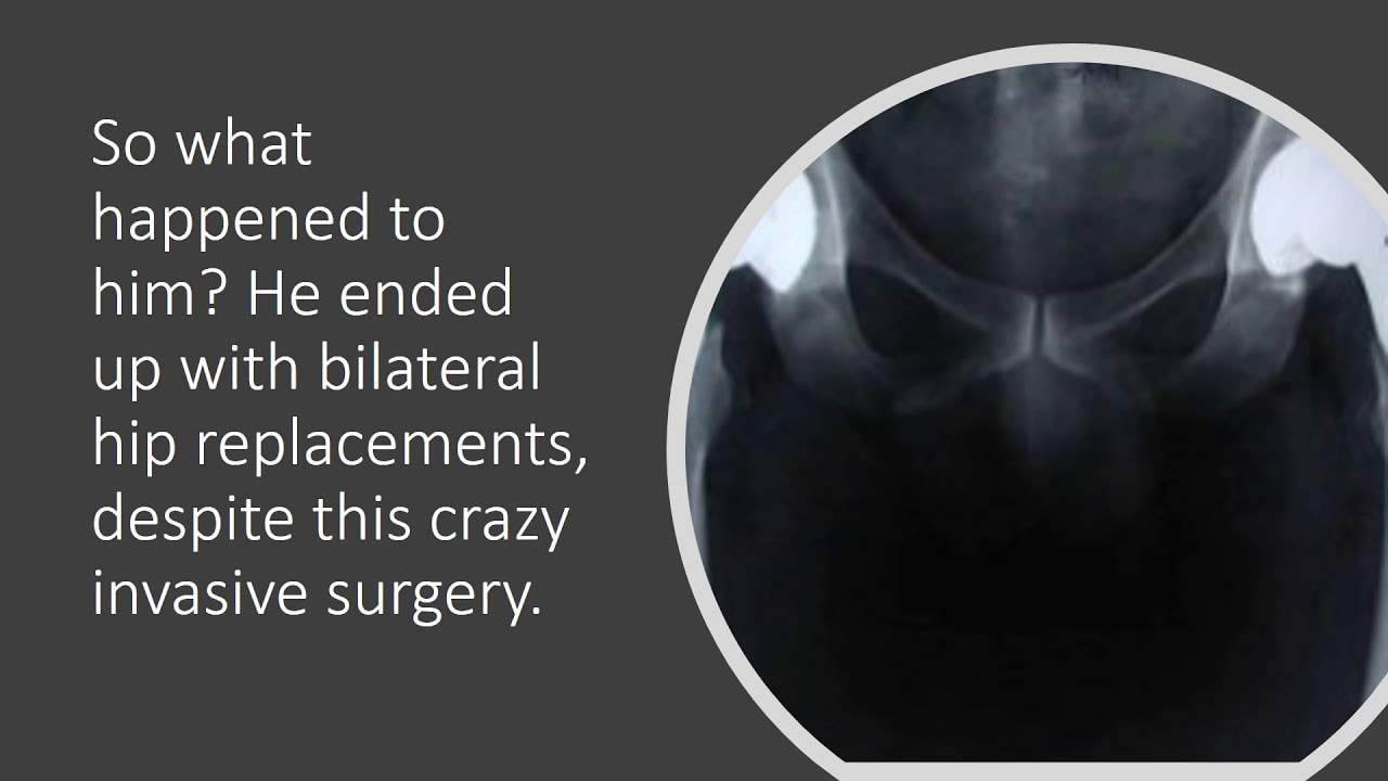 Hip PAO Surgery Complications