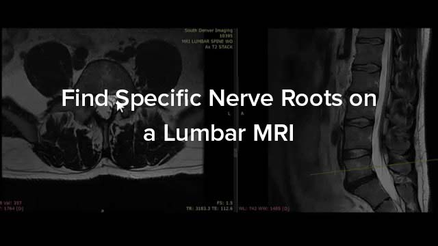 Find Specific Nerve Roots on a Lumbar MRI