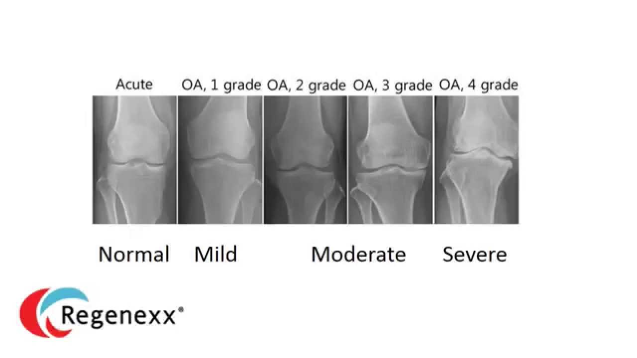 Explain my Knee Arthritis X-Ray