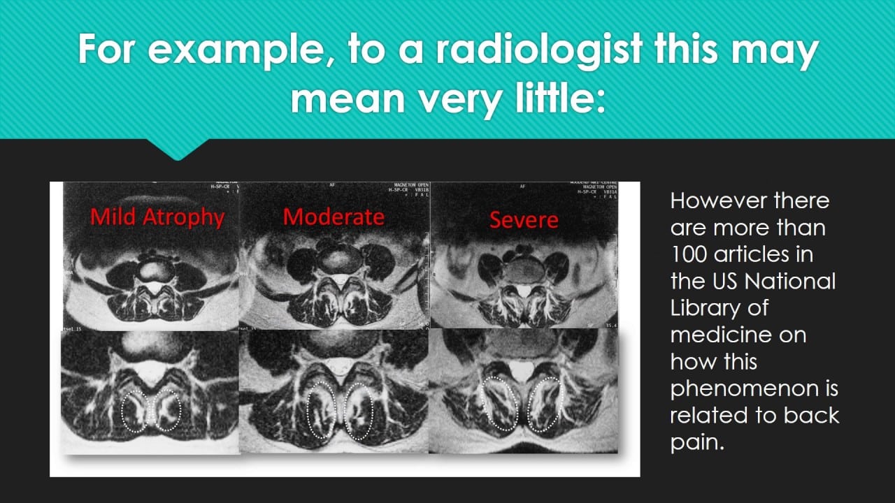 How to Read a Lumbar MRI for Regenerative Medicine Promo