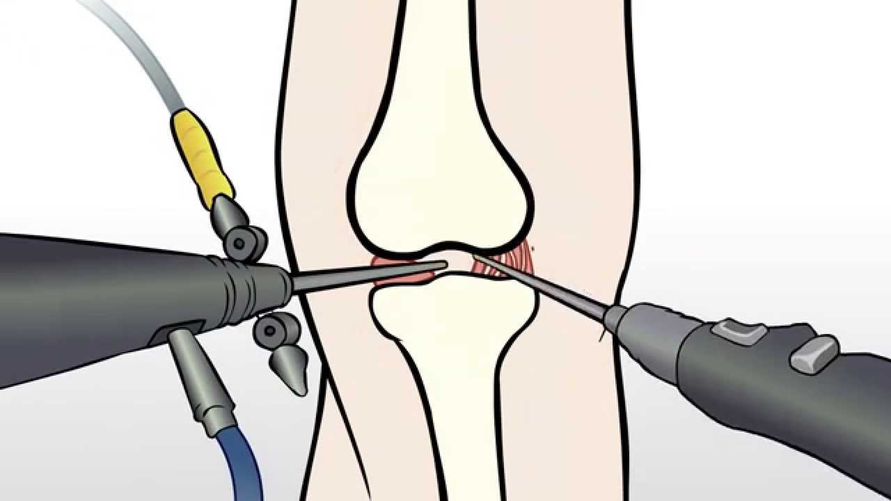 Regenexx Alternative to Knee Meniscus Surgery