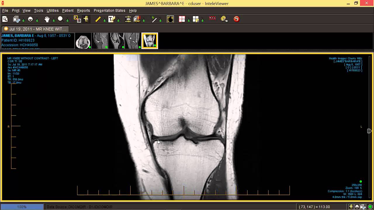 How to Read Knee MRI Regenexx Videos