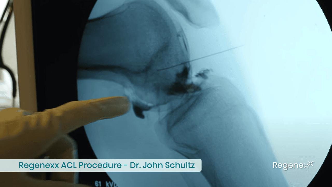 The Regenexx ACL Procedure: In-Depth with Dr. John Schultz