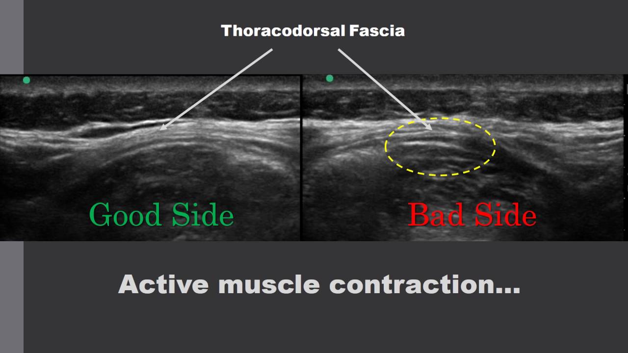 Thoracodorsal fascia ultrasound imaging