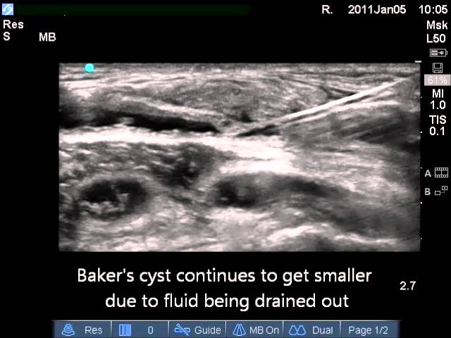 Ultrasound Guidance on Draining and Closing Baker’s Cyst