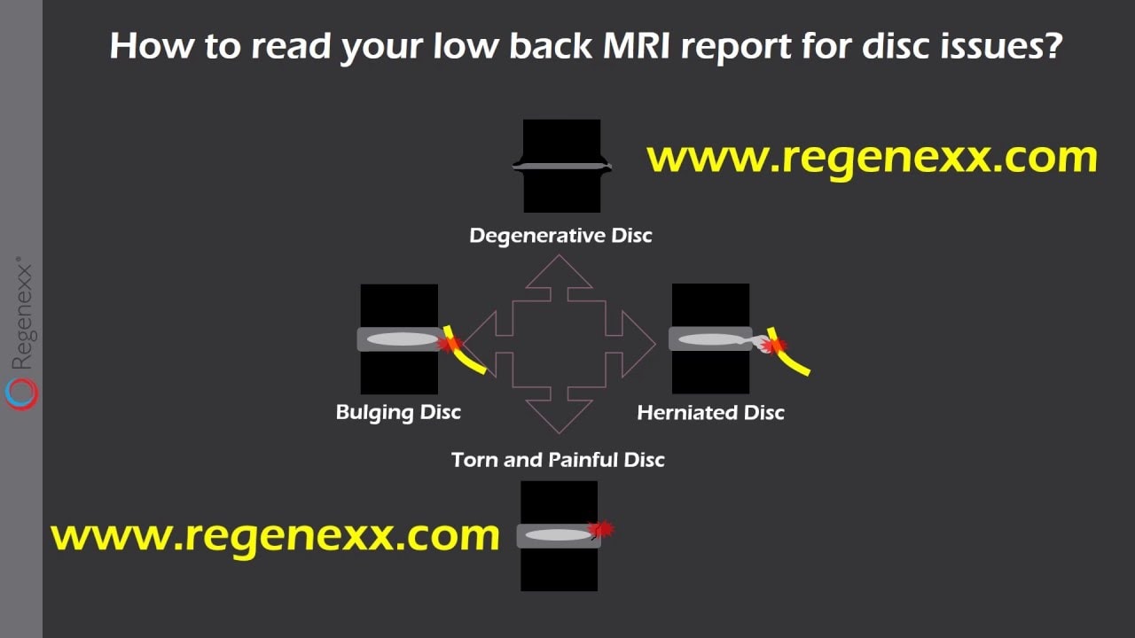 How to Read Your Low Back MRI Report for Disc Issues