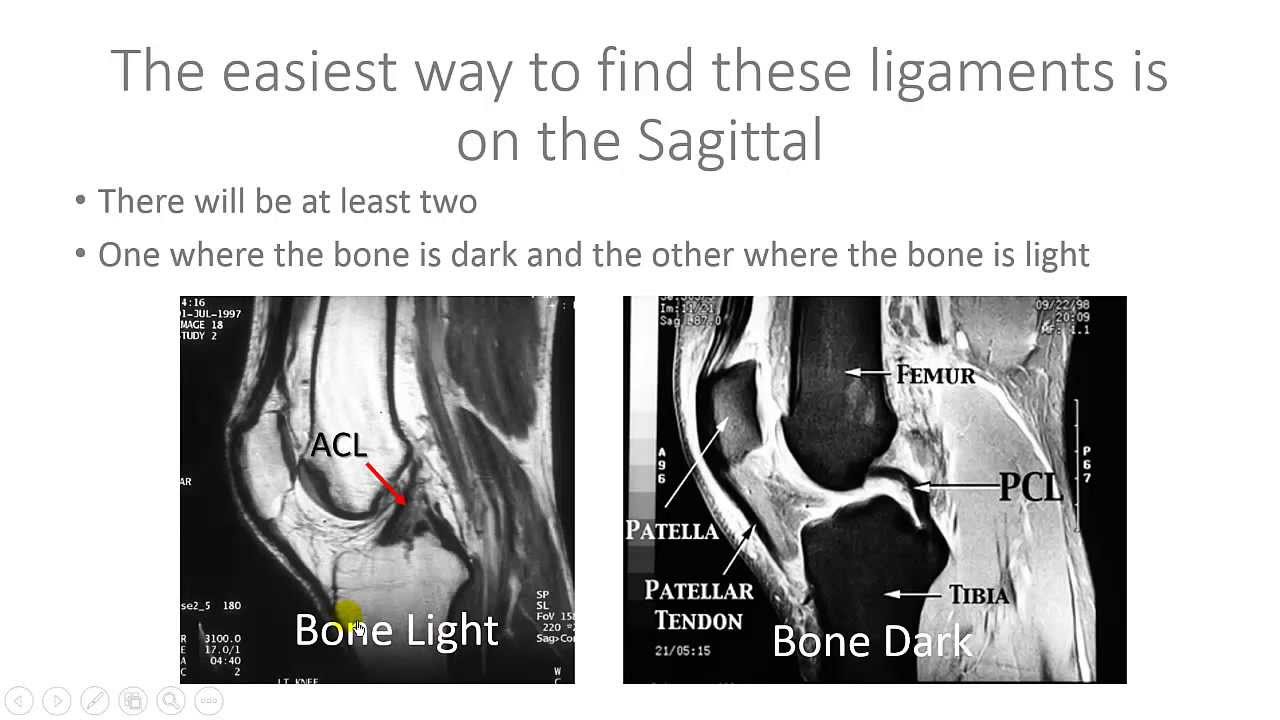 Read Knee MRI for ACL and PCL