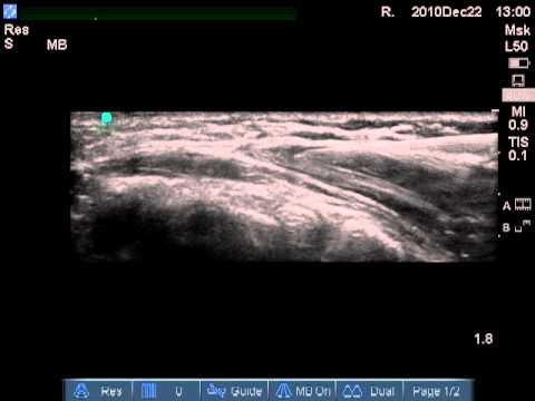 Ulnar Nerve Long Axis