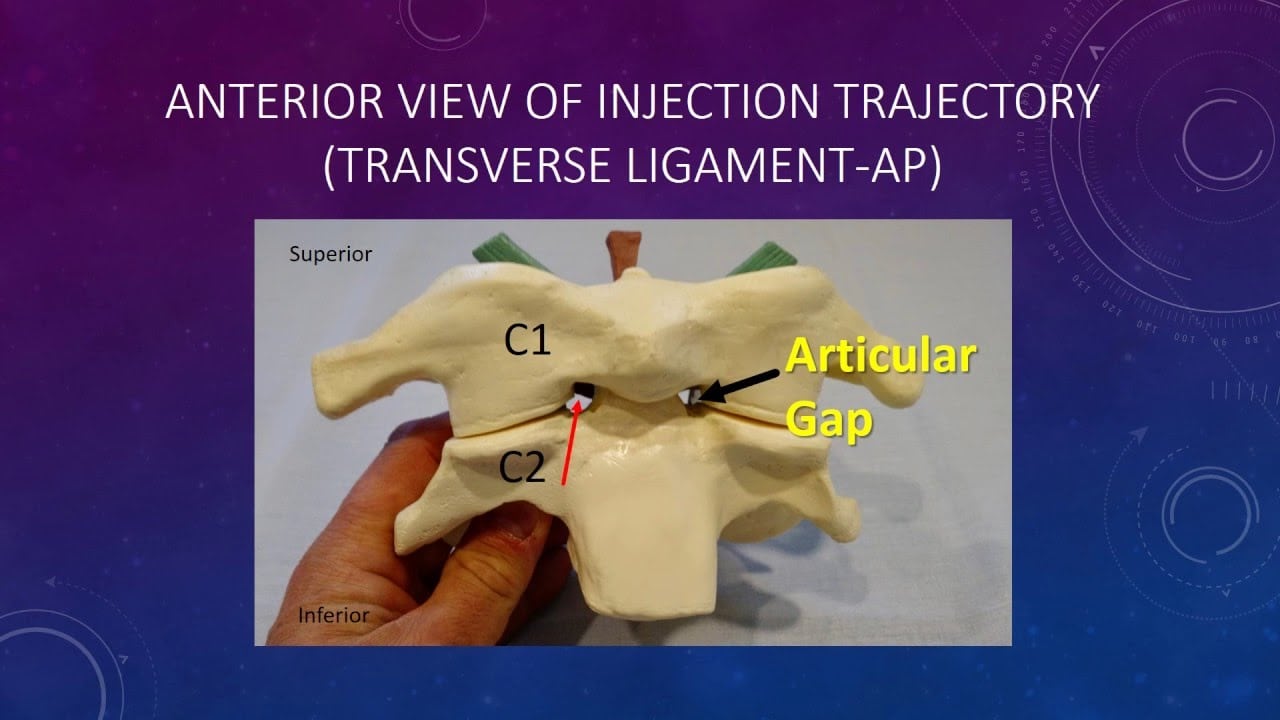Treating Alar Transverse Ligament Injuries without Surgery