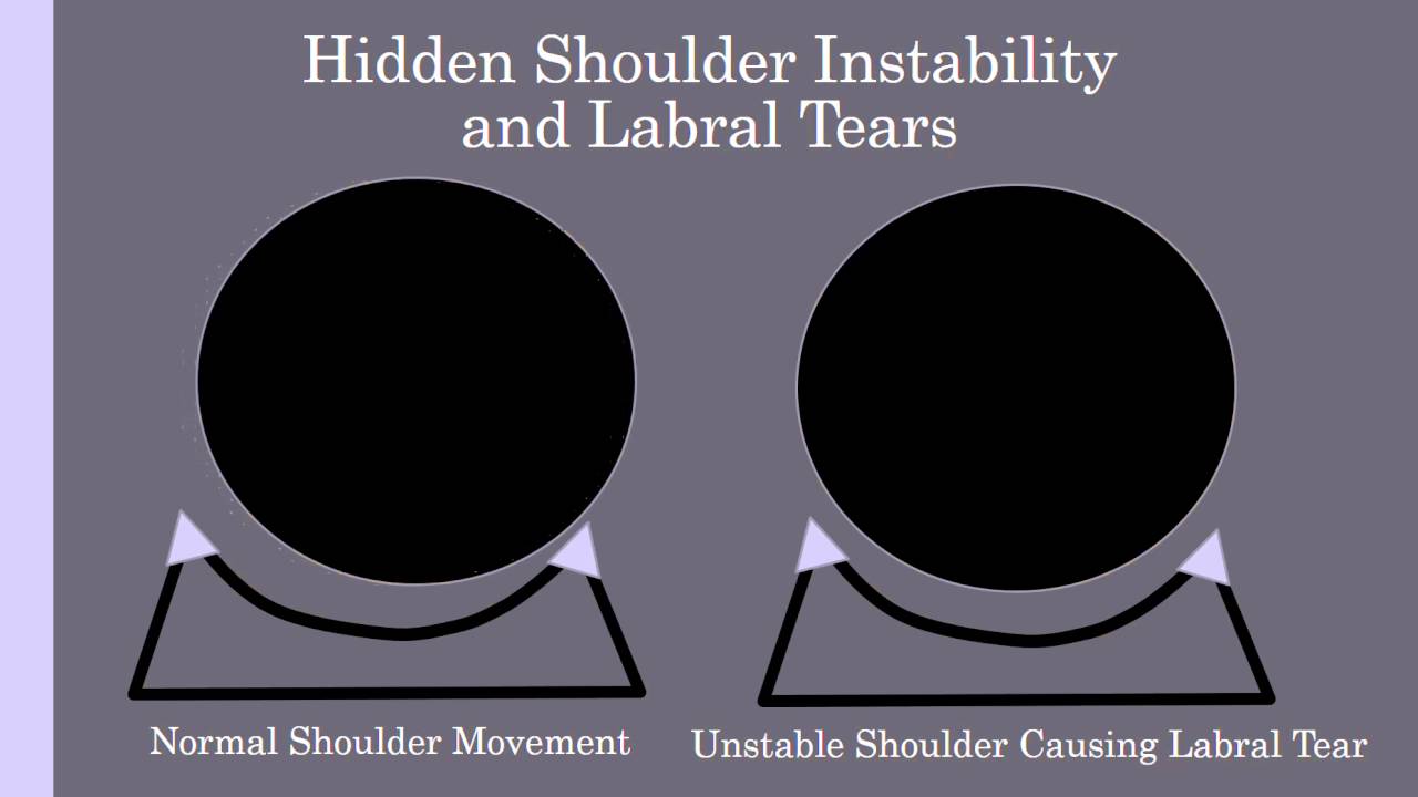 Hidden Shoulder Instability and Shoulder Labral Tears