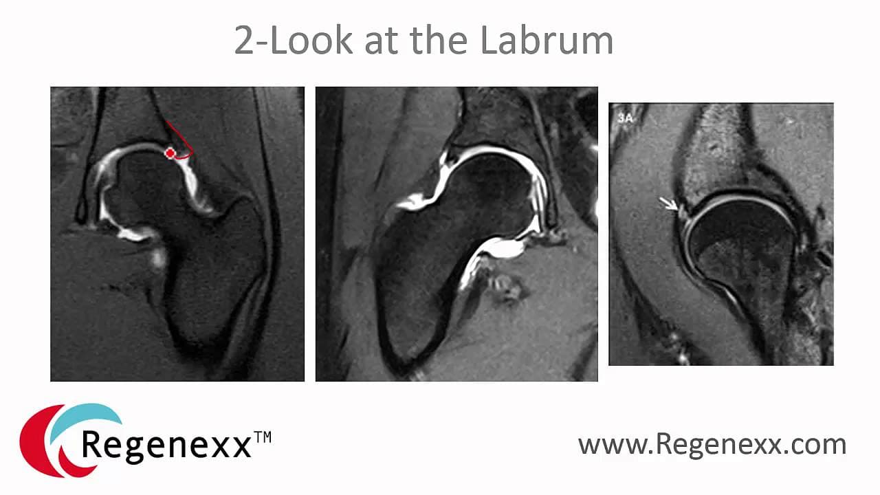 How to Read a Hip MRI: Top 3 Things to Know