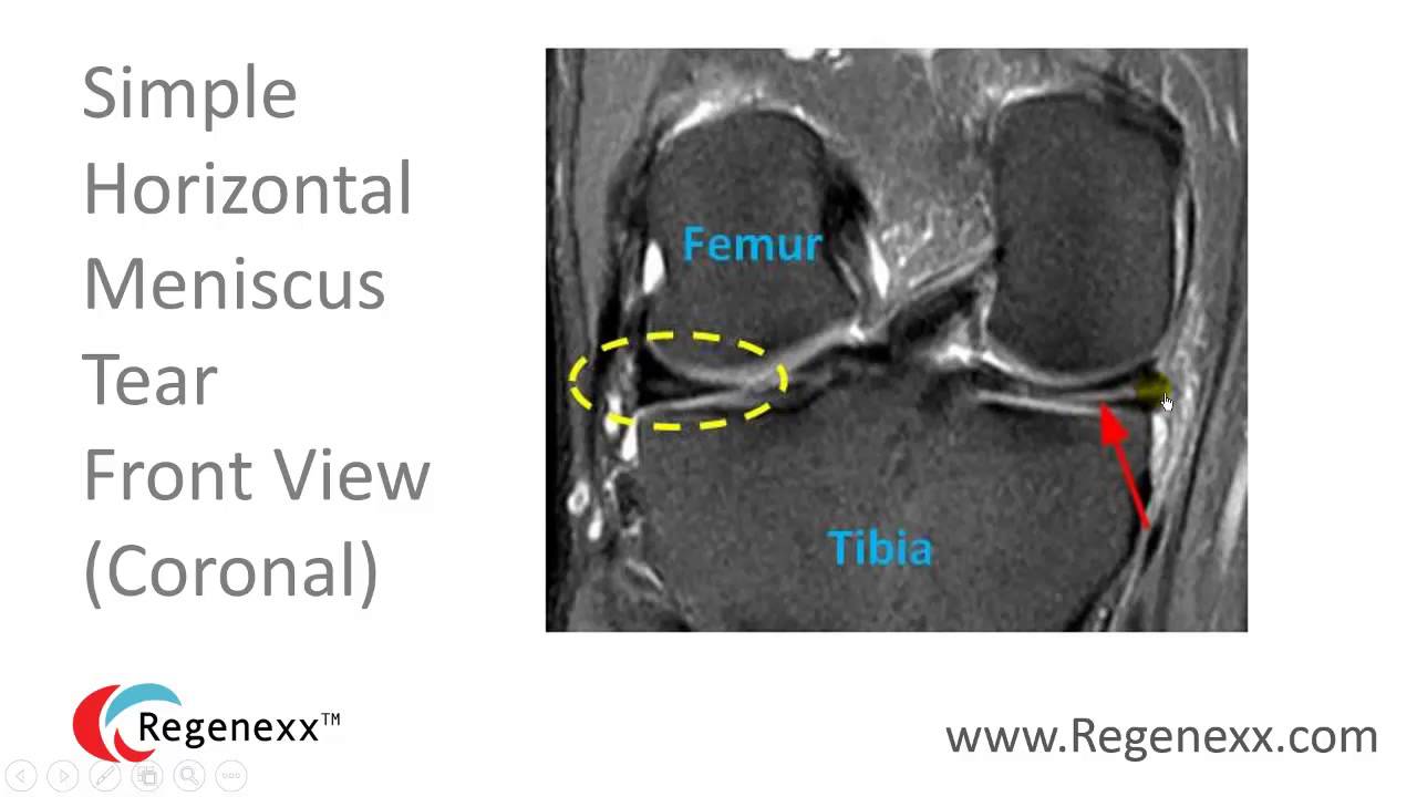 How to Read a Knee MRI for Meniscus Tears