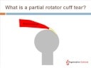 Repairing Rotator Cuff Tear