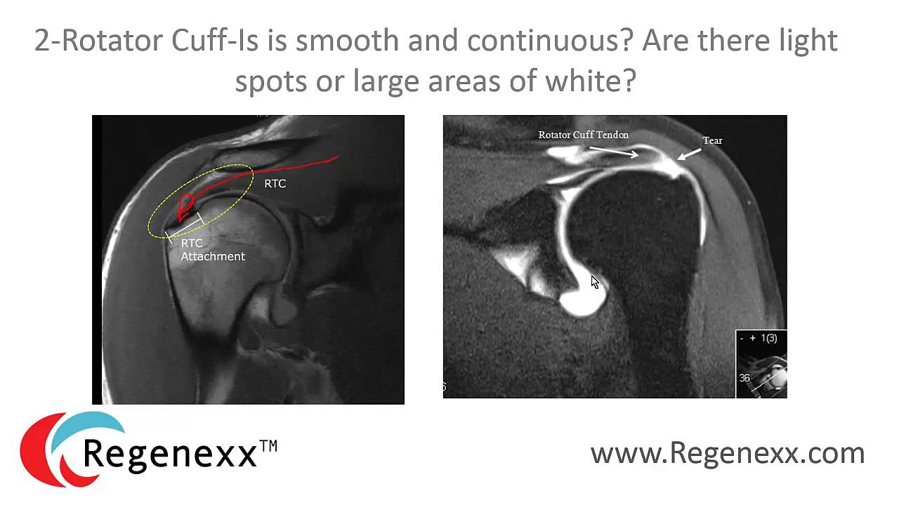 How to Read Your Shoulder MRI