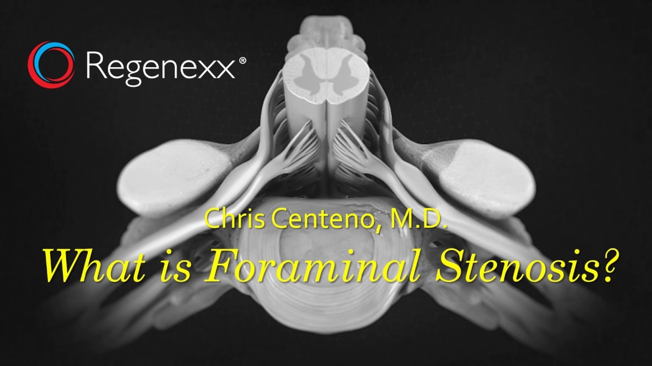 What is Foraminal Stenosis?