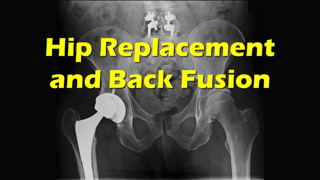 Hip Replacement And Back Fusion