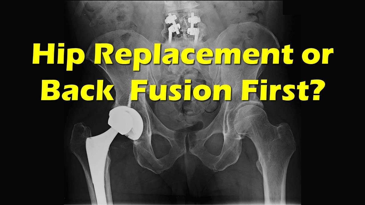 hip replacement and back fusion