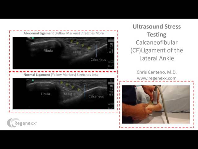 CF Ankle Ligament Ultrasound Stress Test