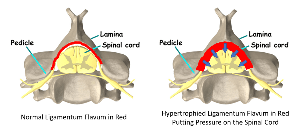 avoid-spinal-stenosis-surgery