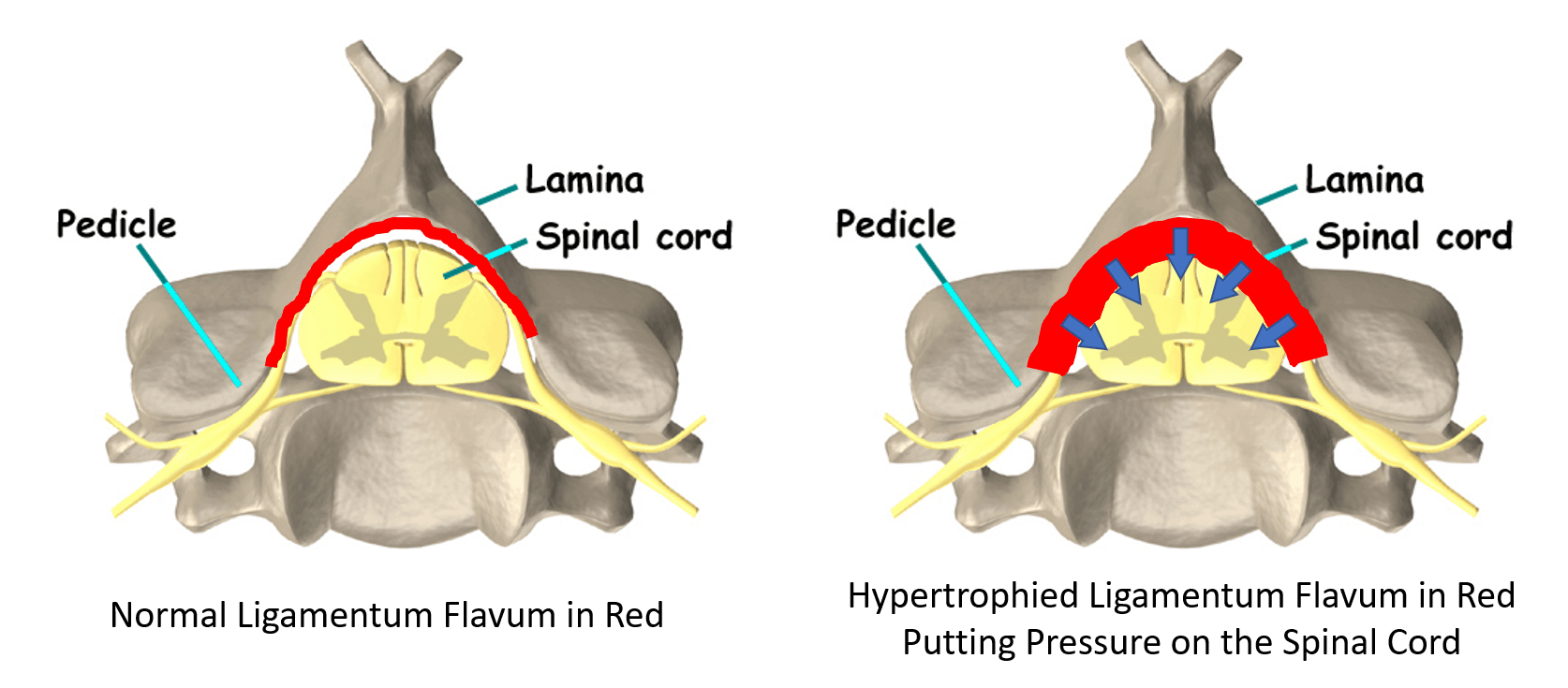 lumbar-stenosis-treatment-without-surgery-regenexx