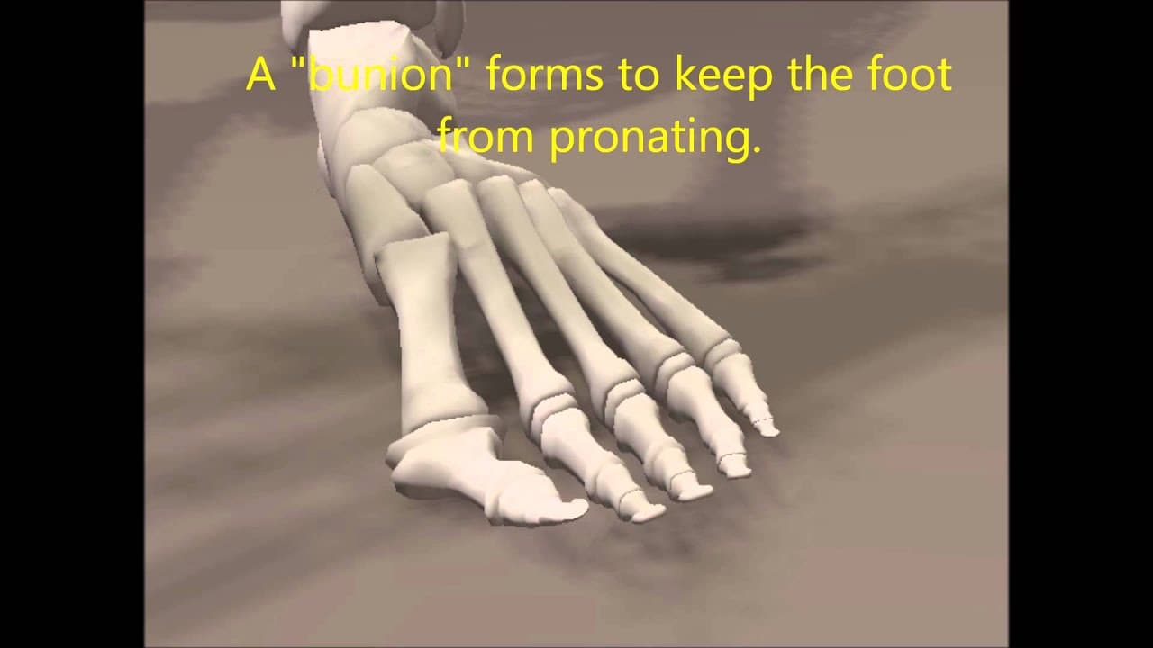 Bunion removal without surgery?
