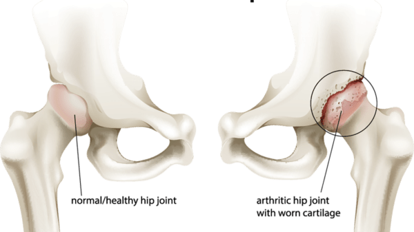 Medical illustration showing the arthritis of the hip joint