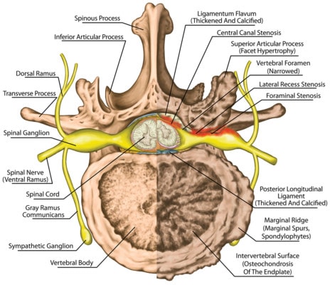 Medical illustration showing a cross section of the spinal cord with a healthy spinal cord on the left and one affected by central canal stenosis on the right