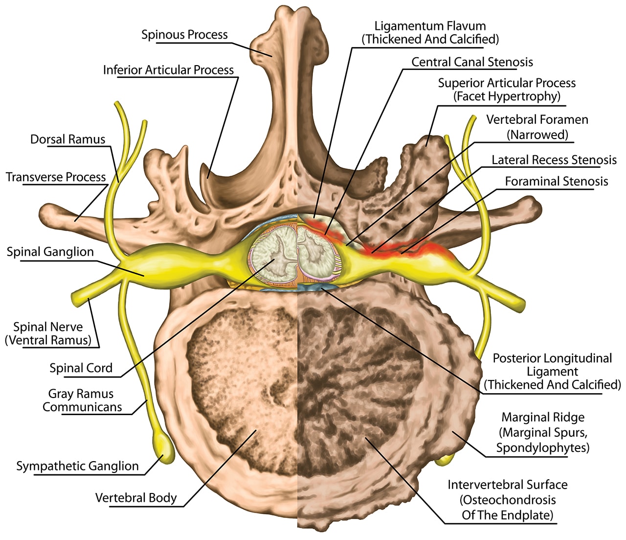 Lateral foraminal Stenosis