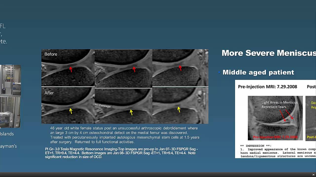Regenexx Stem Cell Procedure Overview Webinar with Dr Centeno