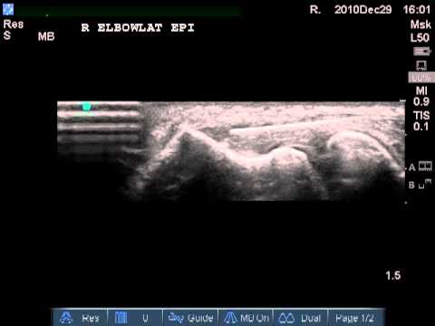 Common Extensor Injection Video