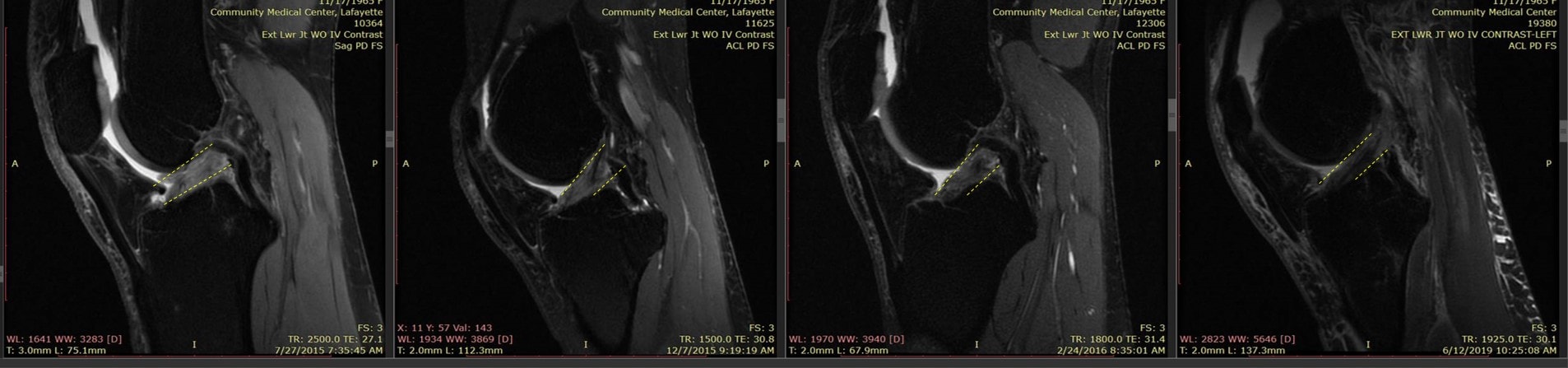 ACL healing with stem cells