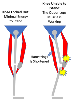 Can't Straighten Your Knee? Here's What Could Be Going On - Regenexx