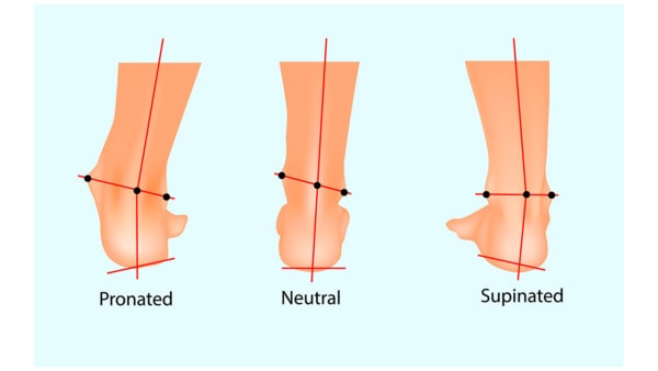 Medical illustration of the normal human foot and the foot with pronation and supination