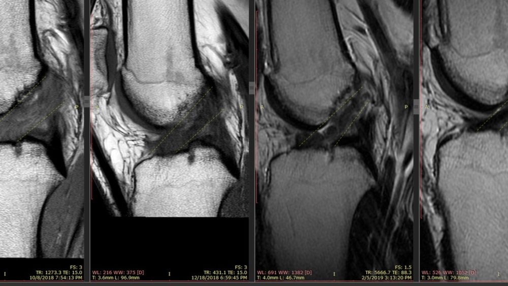 Can a Ligament Grow Back? Getting an Athlete’s ACL to Heal