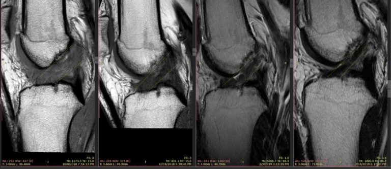 do-ligaments-grow-back-let-s-look-at-the-acl-regenexx