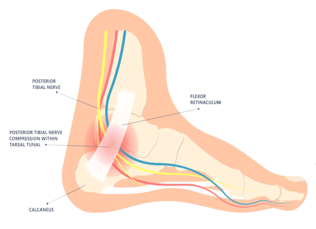 medical illustration of posterior tibial nerve