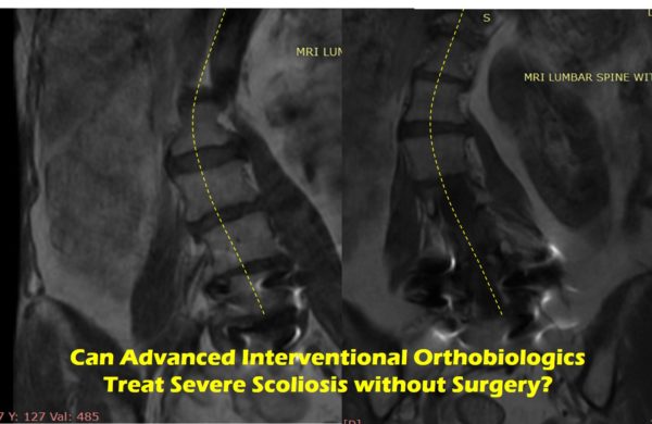 MRIs showing scoliosis of the spine with the text: Can Advanced Interventional Orthobiologics Treat Severe Scoliosis without Surgery?