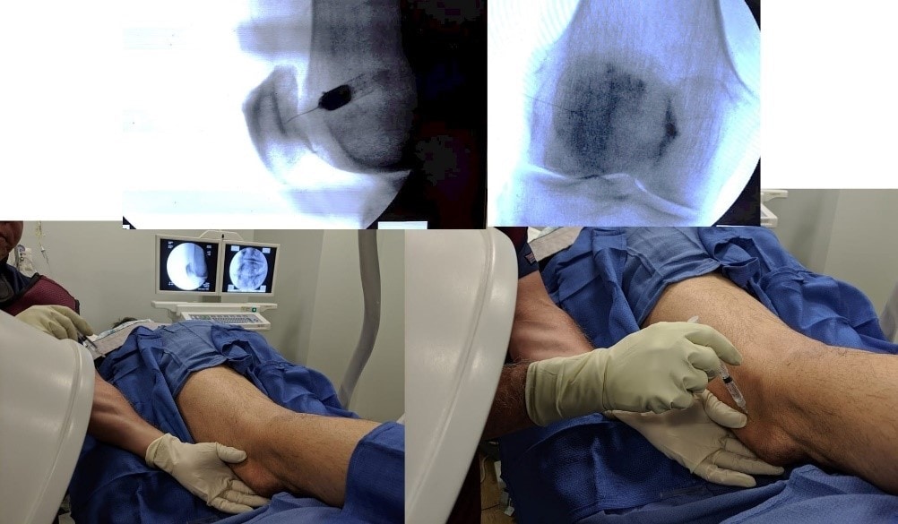 injecting kneecap arthritis