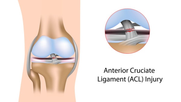 Medical illustration of the knee showing an anterior cruciate ligament, or ACL, injury