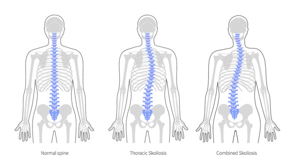 Medical illustration showing a healthy spine and two spines with affected by scoliosis